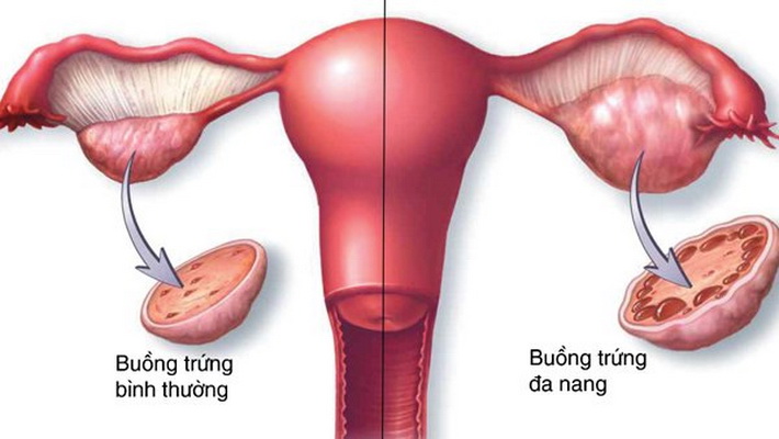 Buồng trứng đa nang là một trong những nguyên nhân thường gặp gây khó thụ thai.